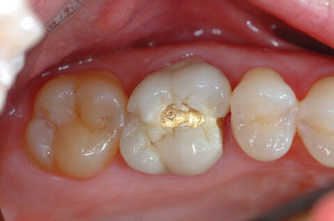 Before Crown