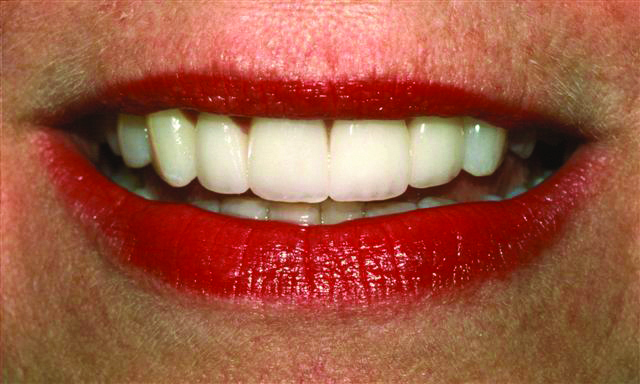 After Veneer