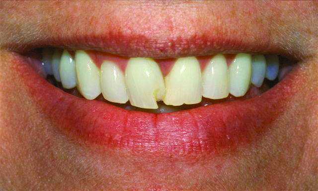 Before Veneer