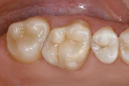 Patient tooth after ceramic inlay treatment