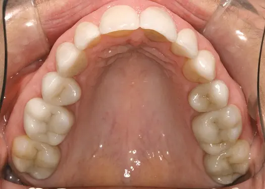 Patient teeth after multi-tooth restorative treatment
