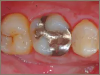 Patient tooth before ceramic onlay treatment